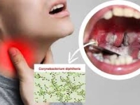 Bệnh bạch hầu tái xuất, làm sao để phòng ngừa?