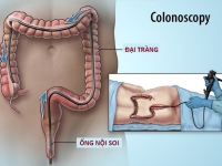 TUỔI NÀO CHO NỘI SOI ĐẠI TRÀNG ?