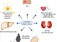 Biến chứng của tăng Acid Uric máu