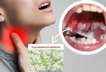 Bệnh bạch hầu tái xuất, làm sao để phòng ngừa?