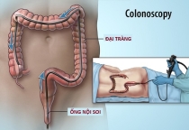 TUỔI NÀO CHO NỘI SOI ĐẠI TRÀNG ?