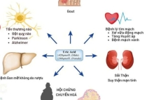 Biến chứng của tăng Acid Uric máu